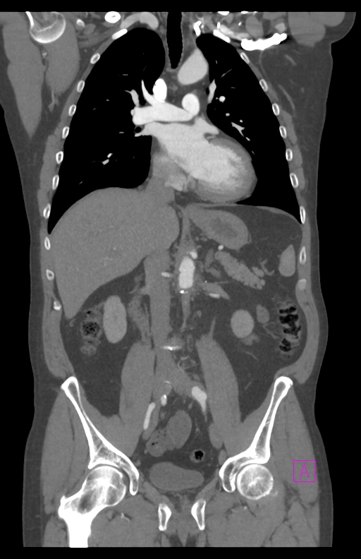 Aortectomy and axillary-bifemoral bypass (Radiopaedia 28303-28545 C 47).jpg