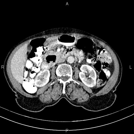File:Aortic aneurysm and Lemmel syndrome (Radiopaedia 86499-102554 A 38).jpg