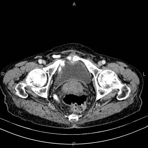 File:Aortic aneurysm and Lemmel syndrome (Radiopaedia 86499-102554 A 76).jpg