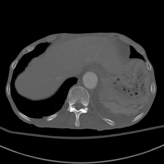 Aortic aneurysm with spinal destruction (Radiopaedia 42301-45410 Axial bone window 14).jpg