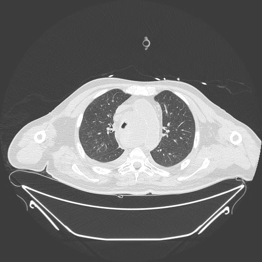 Aortic arch aneurysm (Radiopaedia 84109-99365 Axial lung window 105).jpg