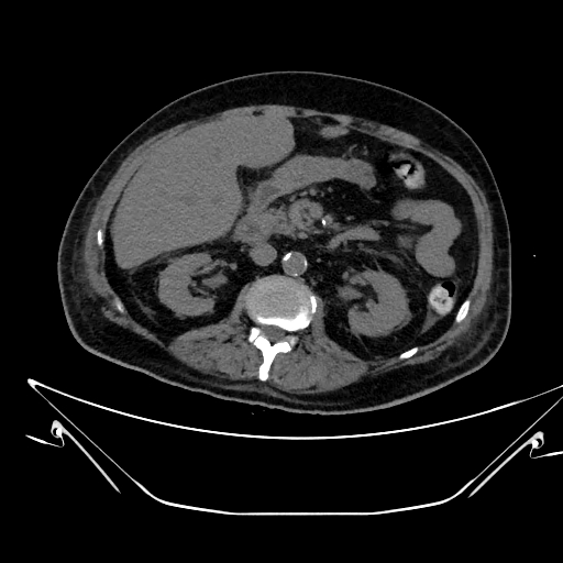Aortic arch aneurysm (Radiopaedia 84109-99365 Axial non-contrast 331).jpg