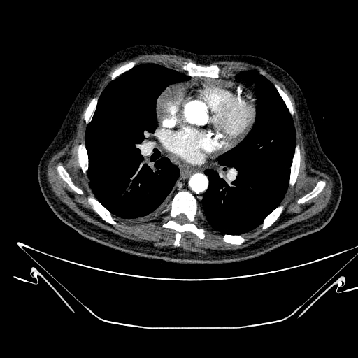 Aortic arch aneurysm (Radiopaedia 84109-99365 B 337).jpg