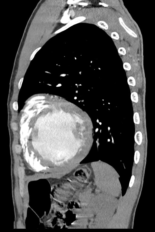 Aortic coarctation with aneurysm (Radiopaedia 74818-85828 B 121).jpg