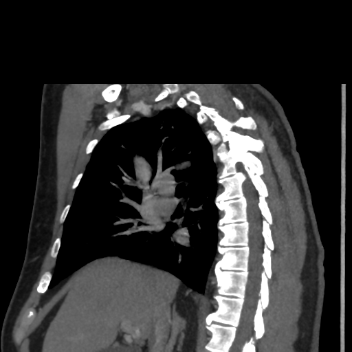 File:Aortic dissection- Stanford A (Radiopaedia 37759-39664 D 5).png