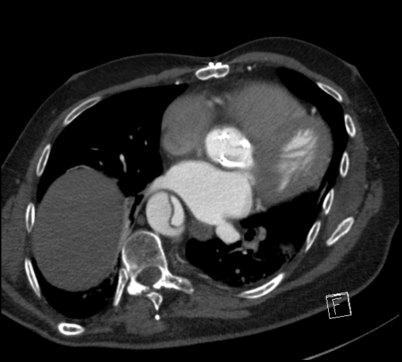 File:Aortic dissection (CTPA) (Radiopaedia 75506-86750 A 57).jpg