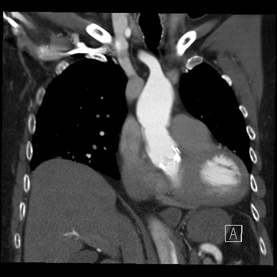 File:Aortic dissection (CTPA) (Radiopaedia 75506-86750 B 27).jpg