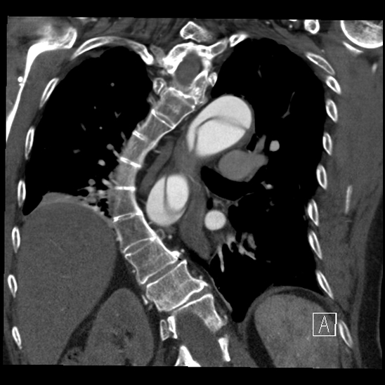 Aortic dissection (CTPA) (Radiopaedia 75506-86750 B 50).jpg