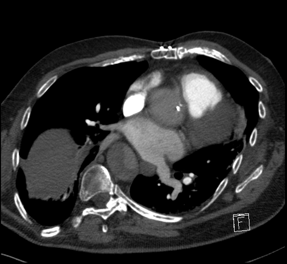 File:Aortic dissection (CTPA) (Radiopaedia 75506-86751 Axial C+ CTPA 80).jpg