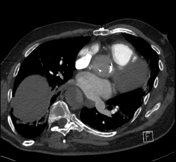 File:Aortic dissection (CTPA) (Radiopaedia 75506-86751 Axial C+ CTPA 82).jpg