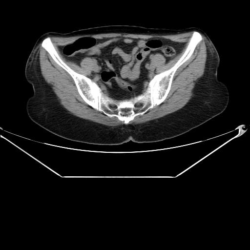 File:Aortic dissection (Radiopaedia 25350-25604 B 65).jpg