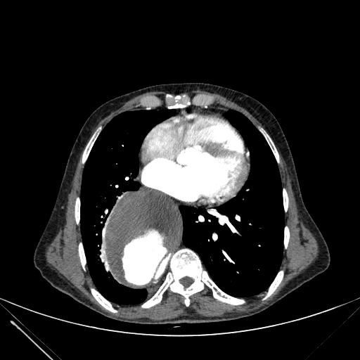 Aortic dissection (Radiopaedia 27466-27665 C+ arterial phase 174).jpg