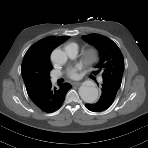 Aortic dissection (Radiopaedia 50763-56234 A 31).png