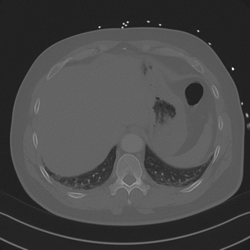 Aortic dissection (Radiopaedia 50763-56234 Axial bone window 86).png