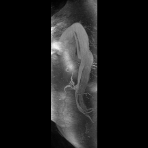 Aortic dissection - Stanford A - DeBakey I (Radiopaedia 23469-23551 D 7).jpg