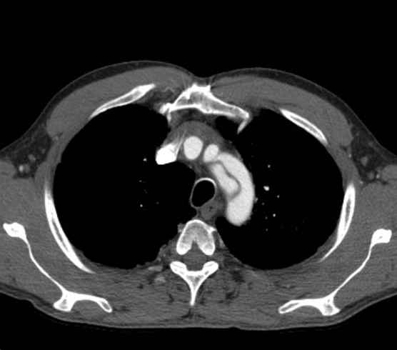 Aortic dissection - Stanford type B (Radiopaedia 73648-84437 A 14).jpg