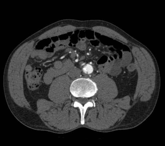 Aortic dissection - Stanford type B (Radiopaedia 73648-84437 A 177).jpg