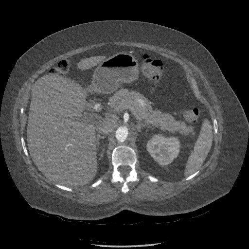 File:Aortic dissection - Stanford type B (Radiopaedia 88281-104910 A 108).jpg