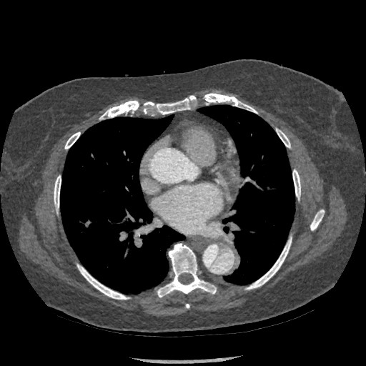 Aortic dissection - Stanford type B (Radiopaedia 88281-104910 A 47).jpg
