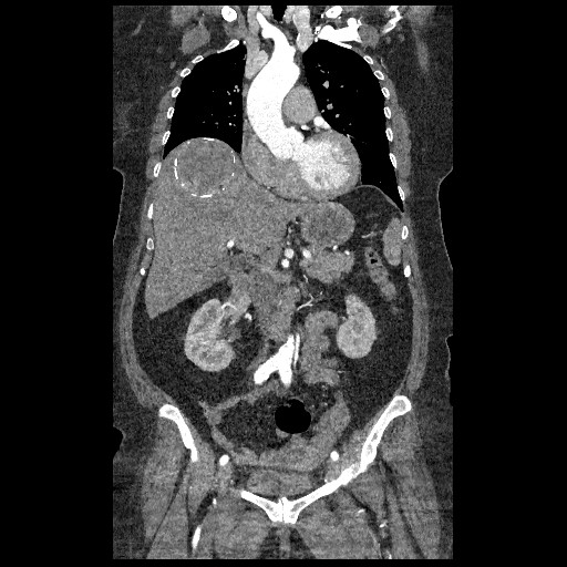 File:Aortic dissection - Stanford type B (Radiopaedia 88281-104910 B 26).jpg