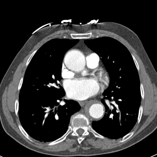 Aortic intramural hematoma (Radiopaedia 31139-31838 B 51).jpg