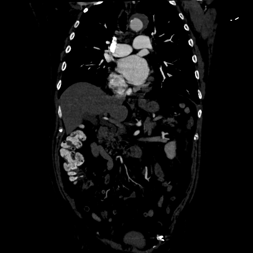 Aortic intramural hematoma (Radiopaedia 34260-35540 C 41).png