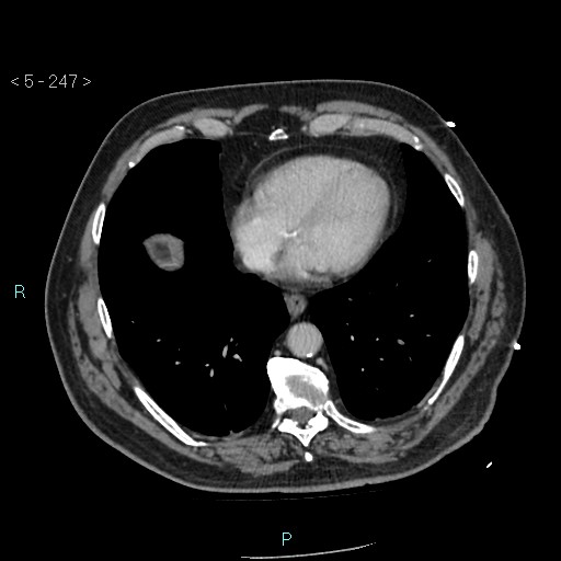 Aortic intramural hematoma (Radiopaedia 48463-53380 C 111).jpg