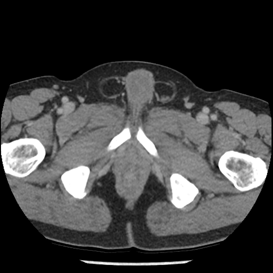 File:Aortic intramural hematoma (type B) (Radiopaedia 79323-92387 Axial C+ delayed 120).jpg