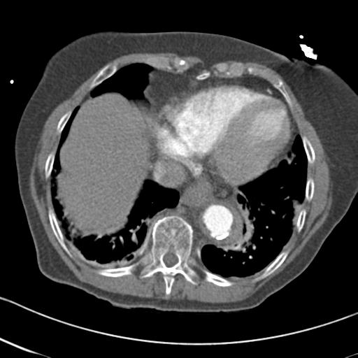 Aortic intramural hematoma from penetrating atherosclerotic ulcer (Radiopaedia 31137-31836 A 61).jpg