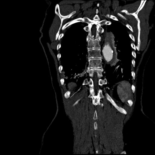Aortic intramural hematoma from penetrating atherosclerotic ulcer (Radiopaedia 31137-31836 C 57).jpg