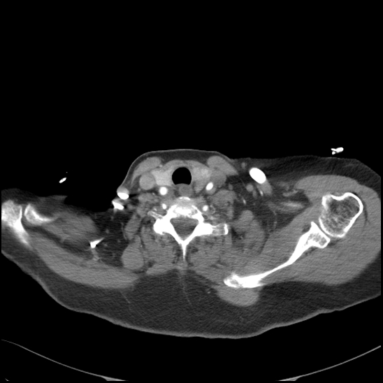 Aortic intramural hematoma with dissection and intramural blood pool (Radiopaedia 77373-89491 B 20).jpg
