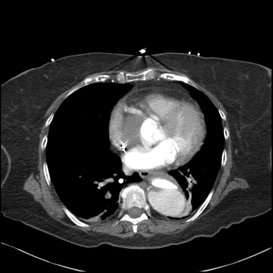 Aortic intramural hematoma with dissection and intramural blood pool (Radiopaedia 77373-89491 B 72).jpg