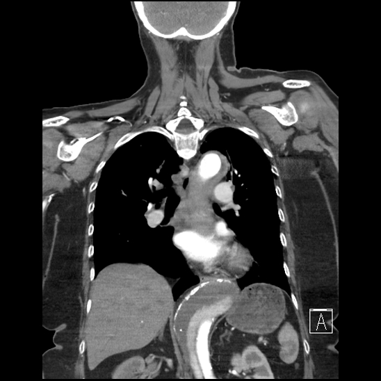 File:Aortic intramural hematoma with dissection and intramural blood pool (Radiopaedia 77373-89491 C 38).jpg
