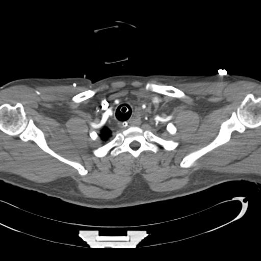 Aortic transection, diaphragmatic rupture and hemoperitoneum in a complex multitrauma patient (Radiopaedia 31701-32622 A 11).jpg