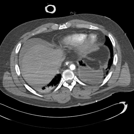 Aortic transection, diaphragmatic rupture and hemoperitoneum in a complex multitrauma patient (Radiopaedia 31701-32622 A 65).jpg