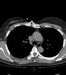 Aortic valve endocarditis (Radiopaedia 87209-103485 Axial non-contrast 37).jpg