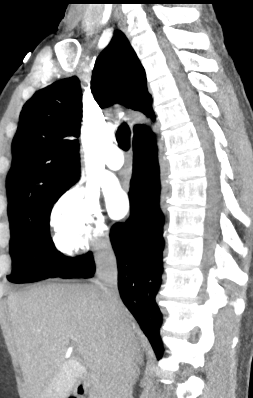 Aortic valve non-coronary cusp thrombus (Radiopaedia 55661-62189 C+ arterial phase 37).png