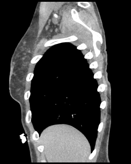 Aortic valve non-coronary cusp thrombus (Radiopaedia 55661-62189 D 46).png