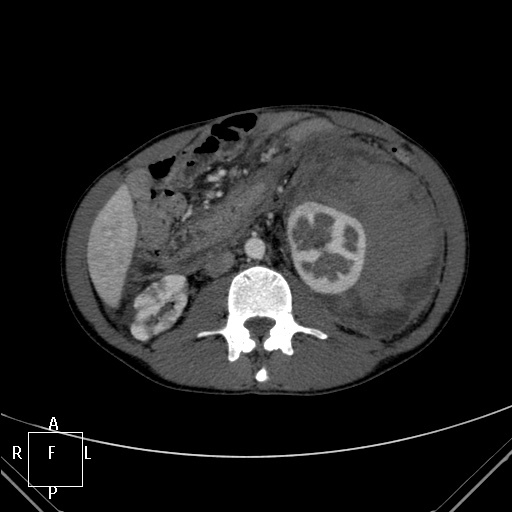 File:Aorto-left renal vein fistula (Radiopaedia 45534-49628 A 30).jpg