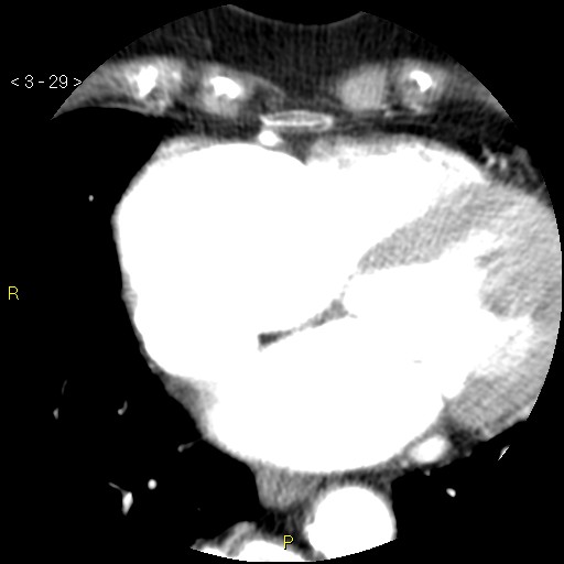 Aortoiliac occlusive disease (Radiopaedia 16828-16548 A 29).jpg