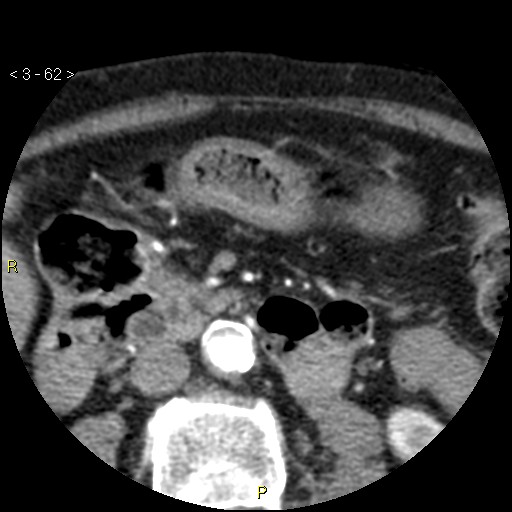 File:Aortoiliac occlusive disease (Radiopaedia 16828-16548 A 62).jpg
