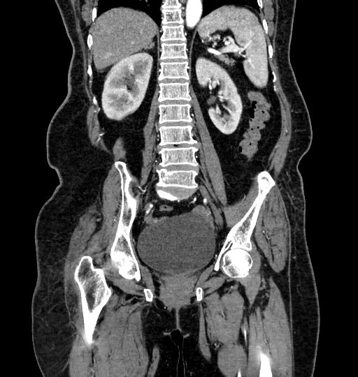 Aortoiliac occlusive disease (Radiopaedia 52352-58248 B 46).jpg