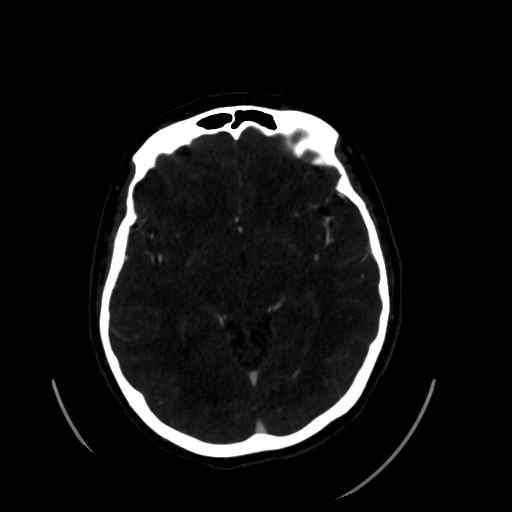 Aplasia of the internal carotid artery (Radiopaedia 61082-68960 A 32).jpg