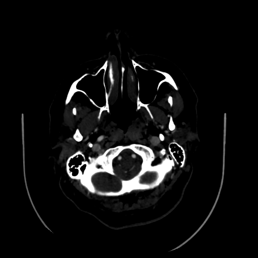 Aplasia of the internal carotid artery (Radiopaedia 61082-68960 A 8).jpg