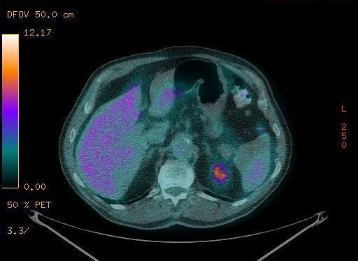 Appendiceal adenocarcinoma complicated by retroperitoneal abscess (Radiopaedia 58007-65041 Axial PET-CT 107).jpg
