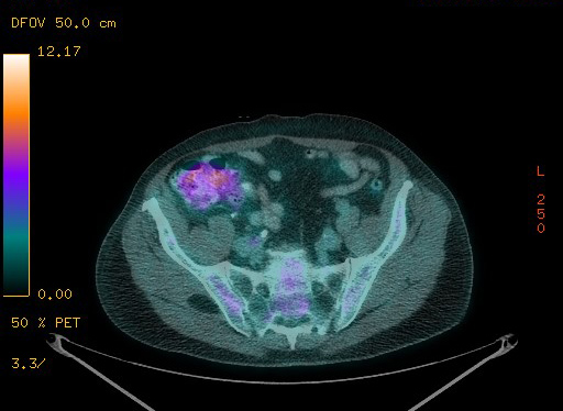 Appendiceal adenocarcinoma complicated by retroperitoneal abscess (Radiopaedia 58007-65041 Axial PET-CT 165).jpg