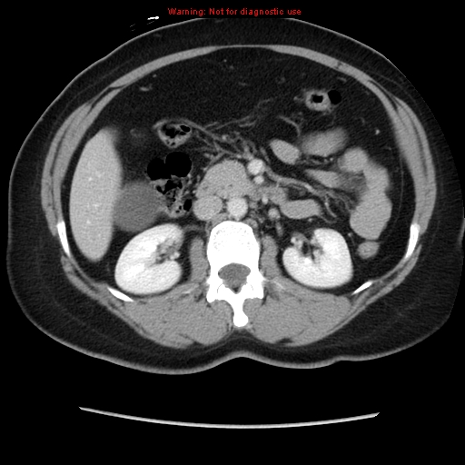 Appendiceal mucinous cystadenoma (Radiopaedia 8263-9111 Axial liver window 35).jpg