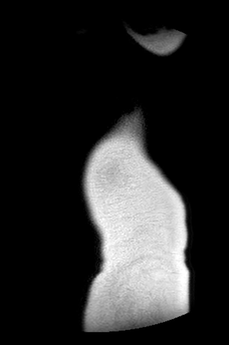 Appendicitis in gravida (MRI) (Radiopaedia 89433-106395 Sagittal T2 65).jpg