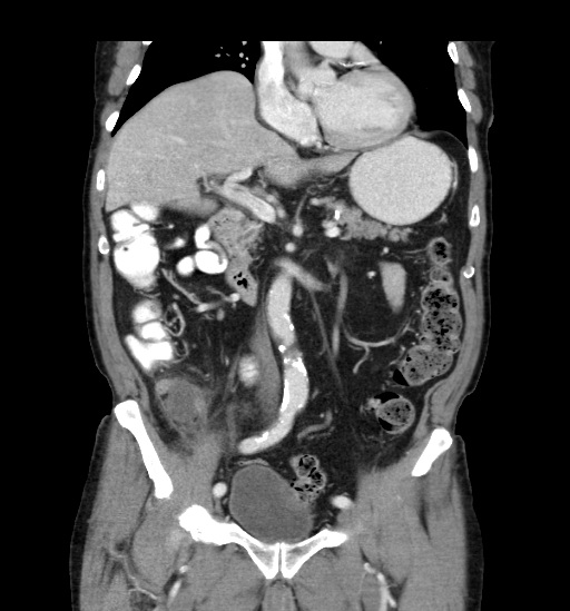 Appendicitis with localized perforation and abscess formation (Radiopaedia 49035-54130 B 23).jpg