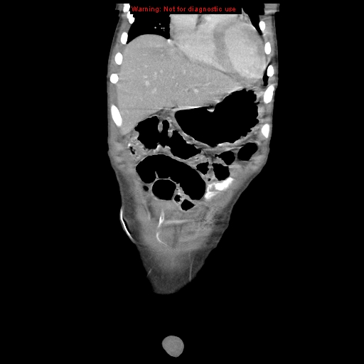 Appendicitis with phlegmon (Radiopaedia 9358-10046 B 12).jpg